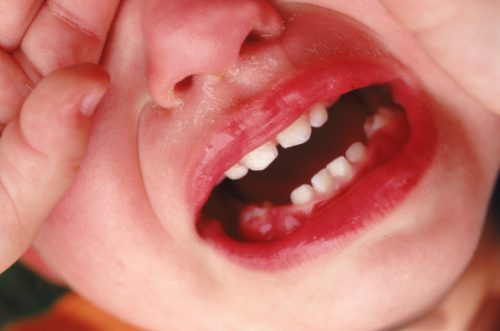 hôi miệng khi mọc răng ở trẻ