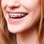 Hướng dẫn cách chăm sóc răng miệng khi niềng răng và những sai lầm hay mắc phải