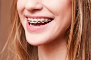 Read more about the article Hướng dẫn cách chăm sóc răng miệng khi niềng răng và những sai lầm hay mắc phải