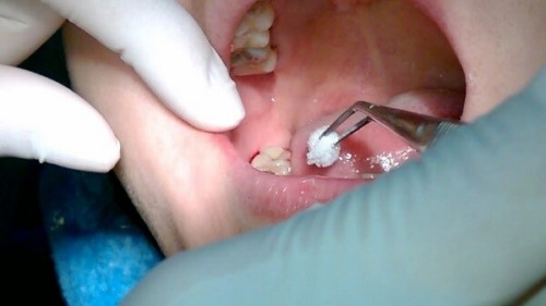 chăm sóc răng miệng sau khi nhổ răng khôn