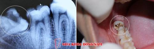 nhổ răng khôn an toàn tại nhakhoadongnam