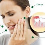 Hướng dẫn cách vệ sinh chăm sóc răng miệng sau khi nhổ răng khôn để không viêm nhiễm