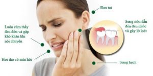 Read more about the article Hướng dẫn cách vệ sinh chăm sóc răng miệng sau khi nhổ răng khôn để không viêm nhiễm