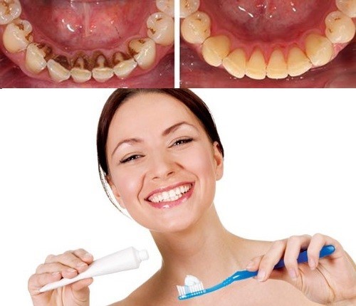 cách chăm sóc răng sau khi lấy cao răng