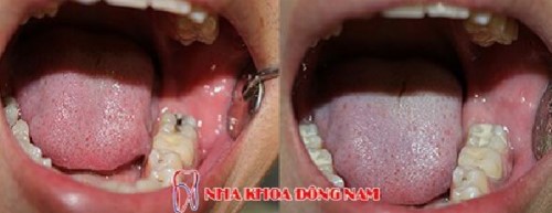 điều trị sâu răng tại nha khoa đông nam