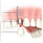 Hướng dẫn chăm sóc răng giả tháo lắp và răng giả cố định đúng cách