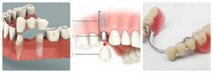 Read more about the article Hướng dẫn chăm sóc răng giả tháo lắp và răng giả cố định đúng cách
