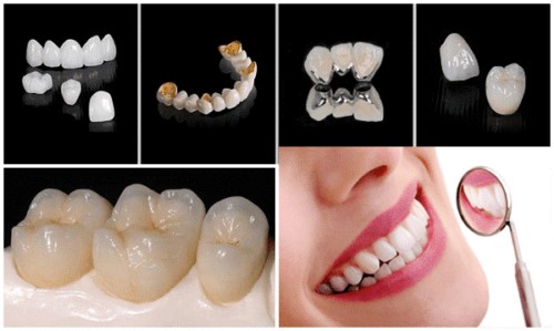 Kết quả hình ảnh cho răng sứ