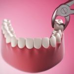 Có nên đánh răng sau khi nhổ răng không?