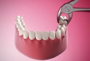 Read more about the article Có nên đánh răng sau khi nhổ răng không?