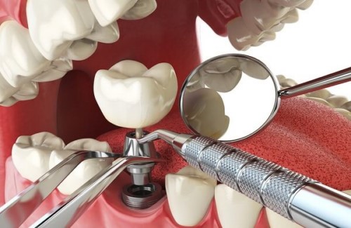 kinh nghiệm đi trồng răng implant