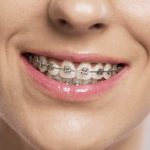 Có hay không việc niềng răng bị hôi miệng? Nguyên nhân và cách khắc phục như thế nào?