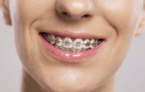 Read more about the article Có hay không việc niềng răng bị hôi miệng? Nguyên nhân và cách khắc phục như thế nào?