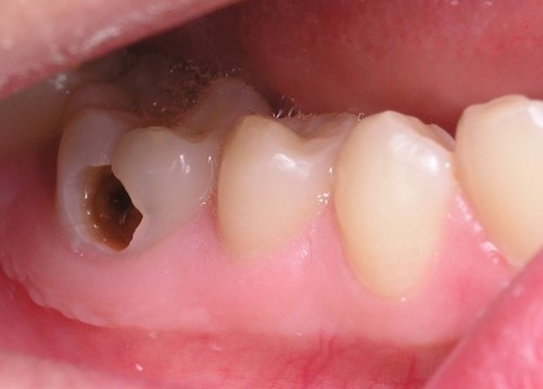 Có loại thuốc nào điều trị sâu răng không-1