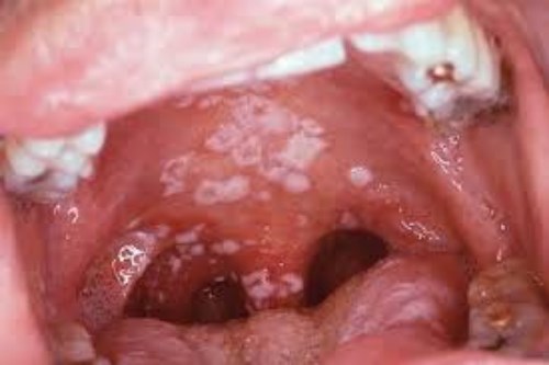 HIV/AIDS và sức khỏe răng miệng-2