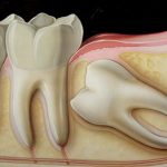 Nhổ răng có ảnh hưởng đến dây thần kinh không?