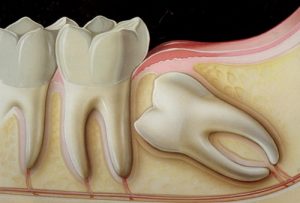 Read more about the article Nhổ răng có ảnh hưởng đến dây thần kinh không?