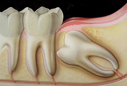 Nhổ răng có ảnh hưởng đến dây thần kinh không-1