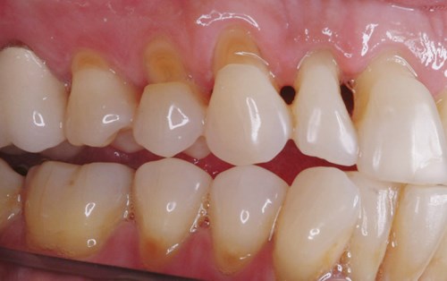 Tại sao răng bị đau nhức khủng khiếp khi uống nước đá lạnh-3