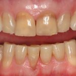 Bị mòn răng mặt nhai điều trị như thế nào?