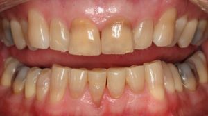 Read more about the article Bị mòn răng mặt nhai điều trị như thế nào?