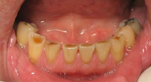Mòn răng nhai điều trị như thế nào