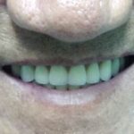 Review – Trồng răng Implant không đau bằng mất răng