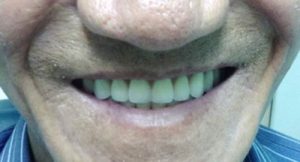 Read more about the article Review – Trồng răng Implant không đau bằng mất răng