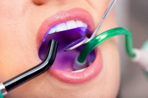 Read more about the article Sau khi trám răng có được đánh răng không?