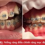 Đeo hàm duy trì sau khi niềng răng trong bao lâu?