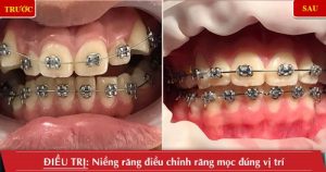Read more about the article Đeo hàm duy trì sau khi niềng răng trong bao lâu?