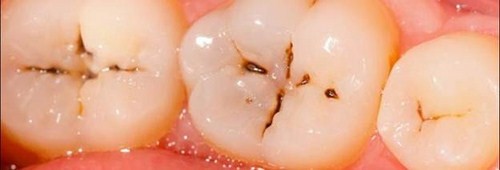 5 dấu hiệu viêm tủy răng nguy hiểm ở trẻ em?;