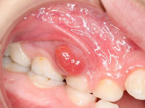 5 dấu hiệu viêm tủy răng nguy hiểm ở trẻ em?
