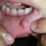Bọng nước trong miệng – Cảnh báo bệnh nguy hiểm