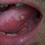Lưỡi mọc mụn trắng là biểu hiện của bệnh gì?