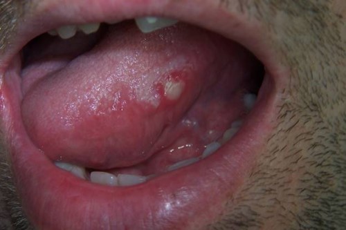 Lưỡi mọc mụn trắng là biểu hiện của bệnh gì?