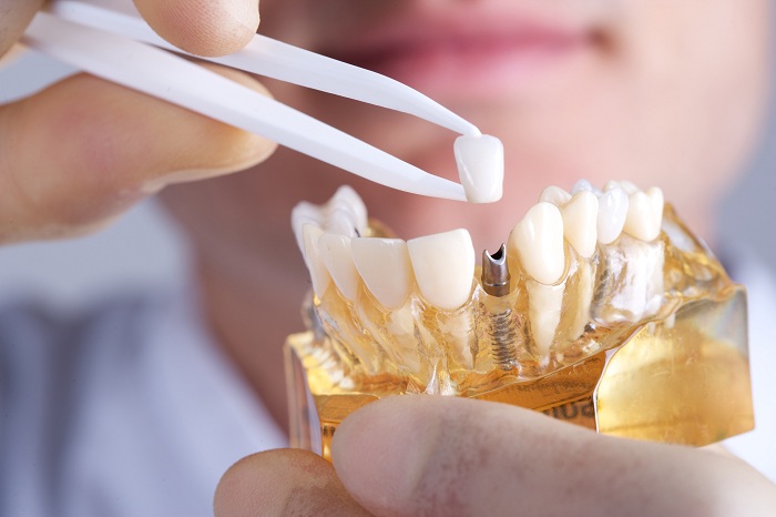 Địa chỉ trồng răng implant uy tín tại TPHCM