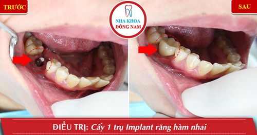 cấy ghép implant cho răng nhai hàm dưới
