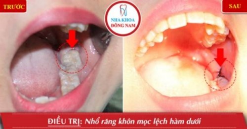 "Đề Cử" 10 nha khoa nhổ răng không đau và an toàn nhất TPHCM