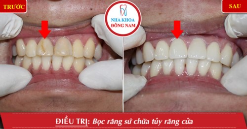 Hình ảnh chữa tủy răng tại Nha khoa Đông Nam