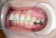 Răng bị trồi thụt sau khi mất cần làm gì?