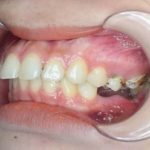 [Hỏi Đáp] Răng bị trồi thụt sau khi mất cần làm gì?