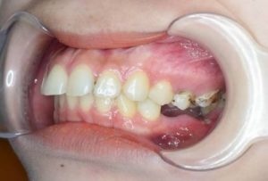 Read more about the article [Hỏi Đáp] Răng bị trồi thụt sau khi mất cần làm gì?