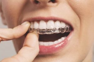 Read more about the article [Hỏi Đáp] Sau khi niềng răng bị chạy là do đâu?