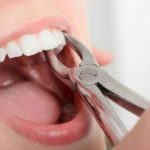 Top 8 địa chỉ nhổ răng khôn an toàn không đau quận Tân Bình