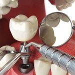 Top 10 địa chỉ cấy ghép răng Implant uy tín nhất quận 1