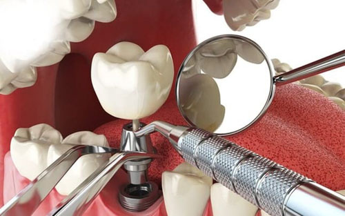 10 địa chỉ cấy ghép răng Implant uy tín nhất quận 1