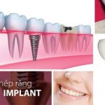 Top 10 địa chỉ nha khoa cấy ghép răng Implant uy tín nhất quận Phú Nhuận