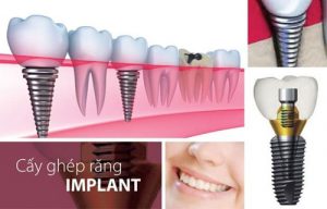 Read more about the article Top 10 địa chỉ nha khoa cấy ghép răng Implant uy tín nhất quận Phú Nhuận