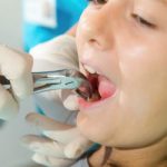Top 10 địa chỉ nhổ răng khôn an toàn và uy tín nhất quận 1